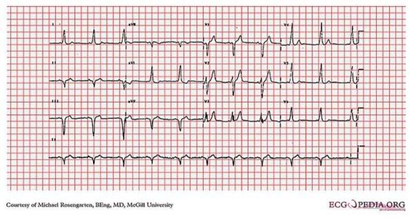 Breakthrough AI tool detects hidden heart disorders from ECG photos