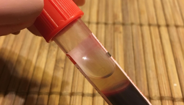 工程师发明了一种可以诊断牙龈炎的家庭测试